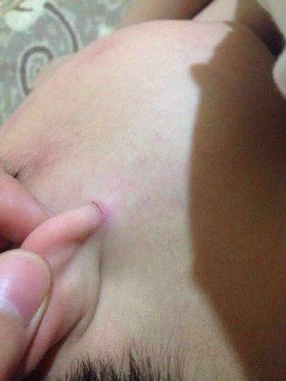 浙江一男童耳垂疑遭撕裂 家长拉横幅堵校门讨说法