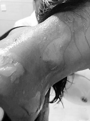 林女士的脖子被烫得脱了皮。人民网照片