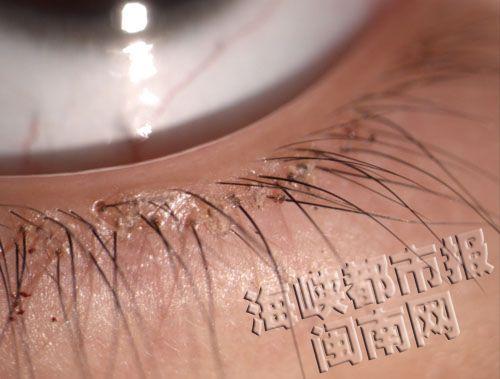 女童眼睫毛长20只阴虱 医生：不注重卫生所致