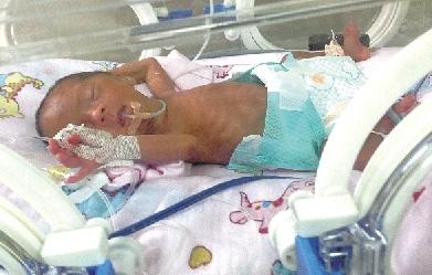 郑州三胞胎姐妹仅有巴掌大 全身皮肤发皱薄如纸