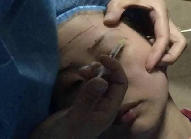 微整形培训黑幕：13毫米的针未消毒插进太阳穴