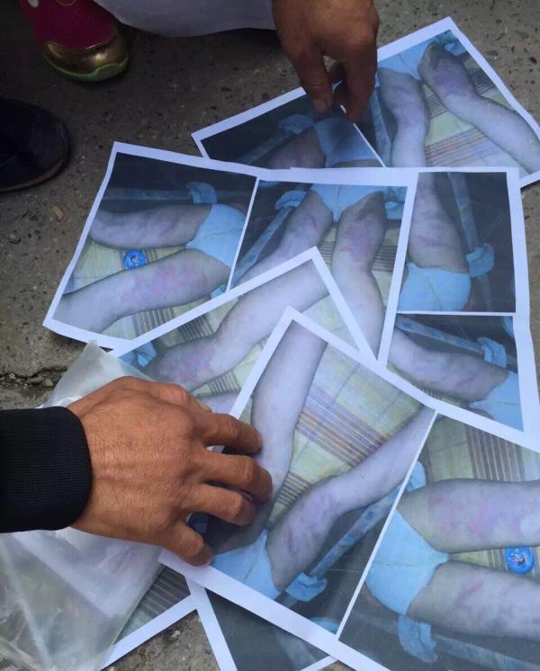 6岁女童遭老师虐待不能平躺 官方：老师是临时工