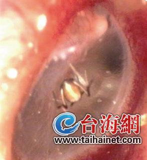女子摘果后耳朵疼 就医发现蜘蛛在耳道结网(图)