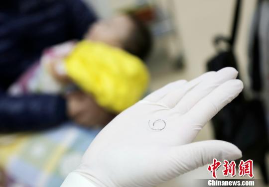 上海医生妙手回春 内镜下取出9月宝宝肚内钢环