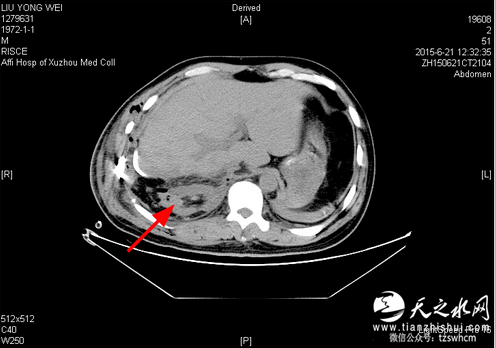 徐州卫计委进驻徐医附院调查右肾“失踪”谜团
