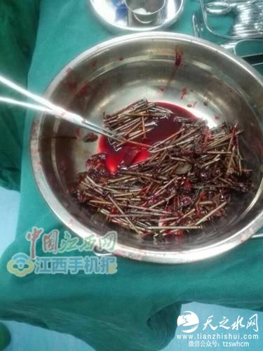 江西15岁少年身体不适 胃中取出200余钉子(图)