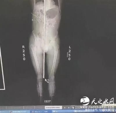 钢筋从右阴囊插入，头顶穿出 图据人民网