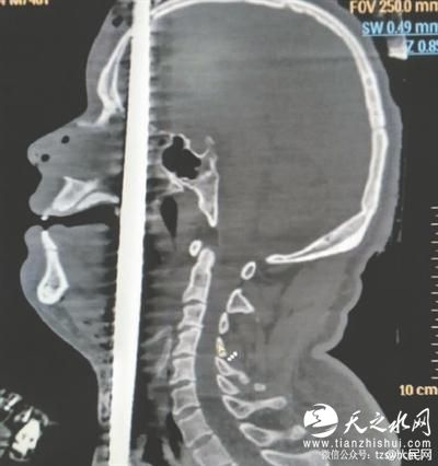 钢筋直穿头顶 男子死里逃生