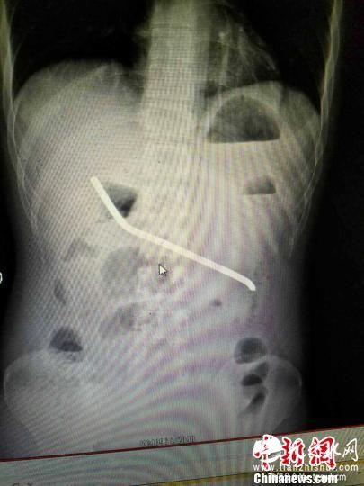 湖南一男子与女友拌嘴怒吞20厘米长钢筋