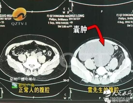 男子腹部隆起似&ldquo;怀孕&rdquo; 一查体内居然有4个肾