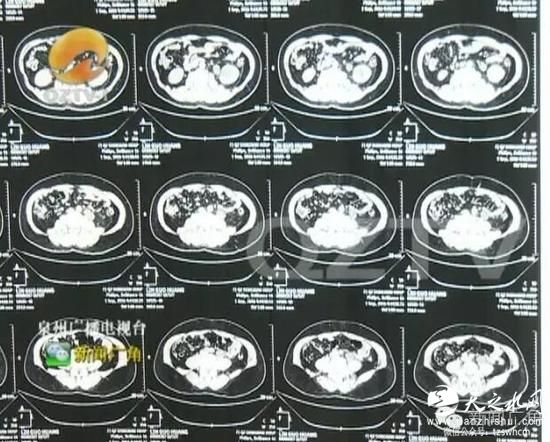 男子腹部隆起似&ldquo;怀孕&rdquo; 一查体内居然有4个肾