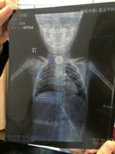 3 岁女童误吞硬币卡喉咙