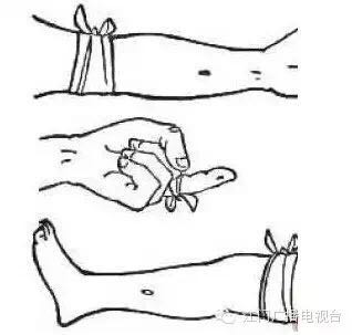 （4）烧灼：第一时间烧灼伤口，用打火机、火柴等都可以，烧灼约5-10秒，使毒素在高温下变质而失去毒性。