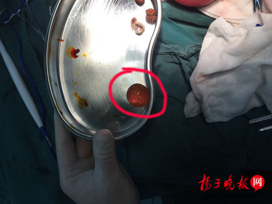 医生从一岁小军体内取出的已膨胀至乒乓球大小的“水宝宝”玩具。 图由医院提供。