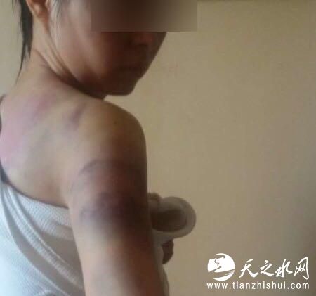 张晓燕生前向家人展示过身上的伤痕，图为张晓燕的姐姐拍摄。