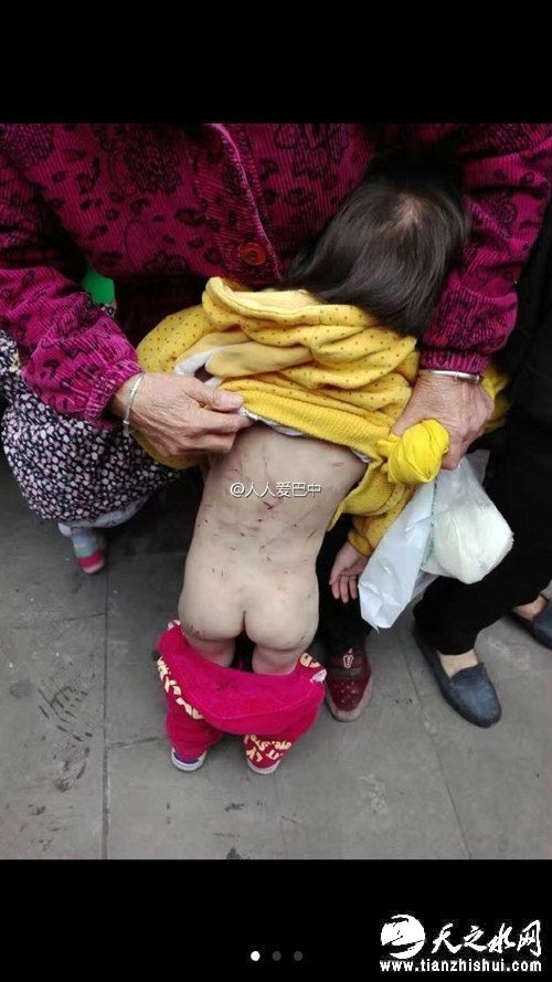 女童后背出现多处伤痕。 来源：@人人爱巴中